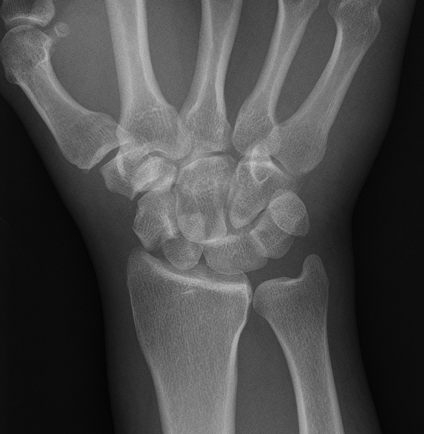 Transscaphoid Perilunate Dislocation